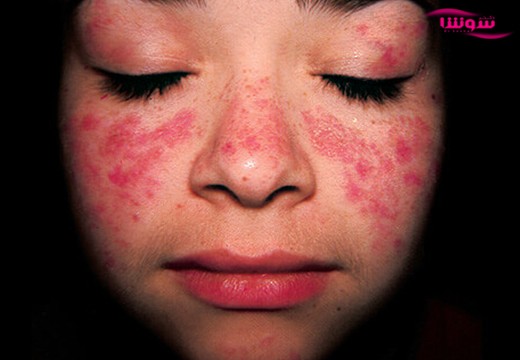 لوپوس (Lupus)