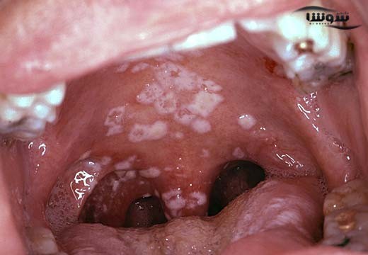برفک دهان (Oral thrush)