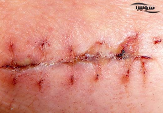 اسکار | جای زخم ( Scar)