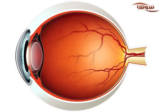 پیر چشمی (Presbyopia)