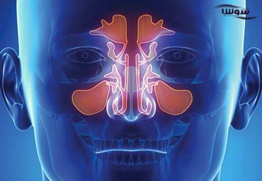سینوزیت مزمن (Chronic sinusitis)