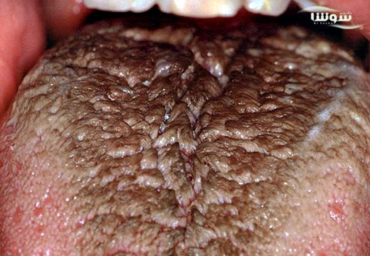 زبان مودار سياه (black Hairy Tongue)