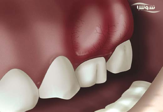 آبسه دندان (tooth-abscess)