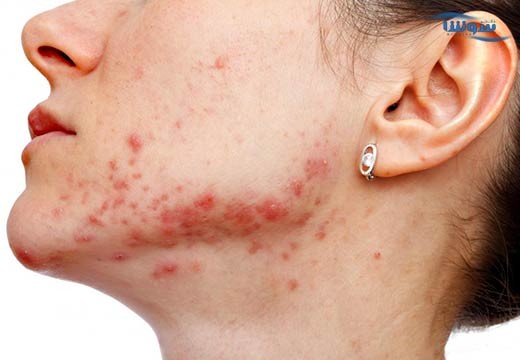 آکنه باکتریایی | آکنه وولگاریس (Bacterial acne)