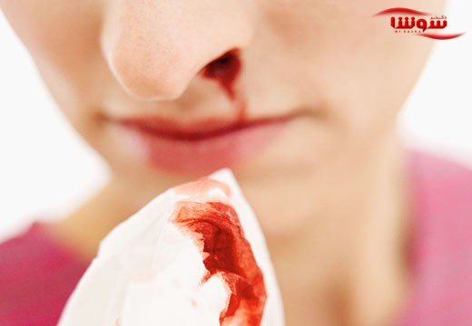 خوندماغ (Nose bleeding)