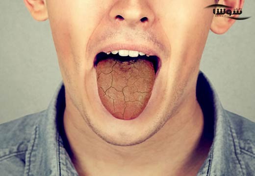 خشکی دهان (Dry mouth)