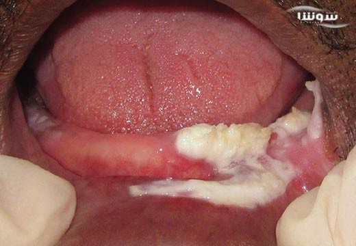 لکوپلاکیا (leukoplakia)