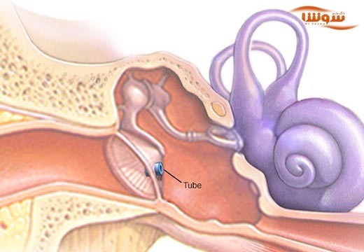 عفونت گوش میانی (middle ear infection)