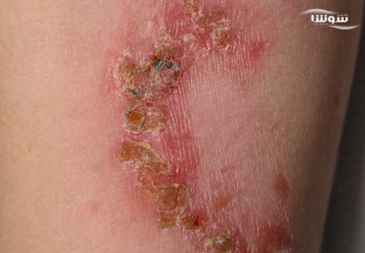 عفونتهای انگلی پوست | لیشمانیازیس-گال-شپش (Parasitic skin infections)
