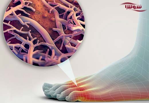 عفونتهای قارچی (Fungal infections)