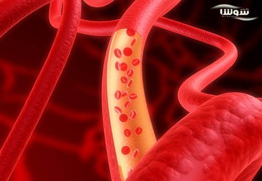 سندروم کارسینوئید (Carcinoid syndrome)