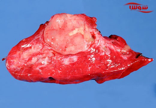 تومور کارسینوئید (Carcinoid Tumor)