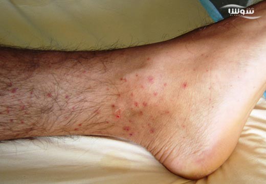 گرانولوماتوز مزمن (Chronic granulomatous)