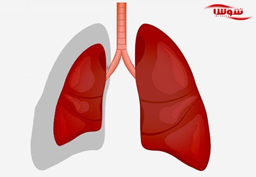 آتلکتازی (atelectasis)