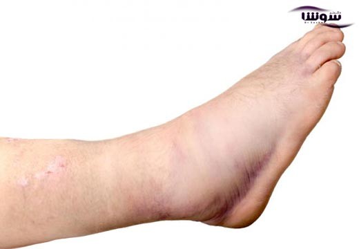 ادم | تورم اندامها (Edema)