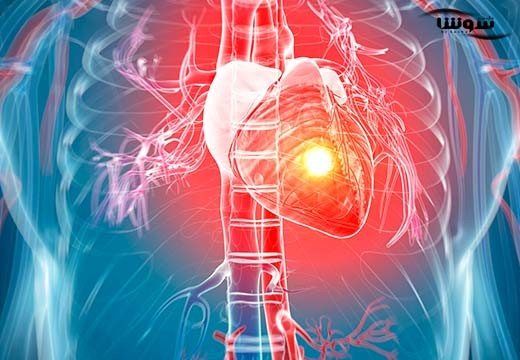 حمله قلبی | سکته قلبی | انفارکتوس قلبی (Heart attack)
