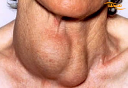 تیروئیدیت هاشیموتو (Hashimoto’s thyroiditis)