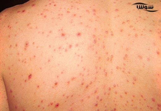 مشکلات پوستی (skin disorders)