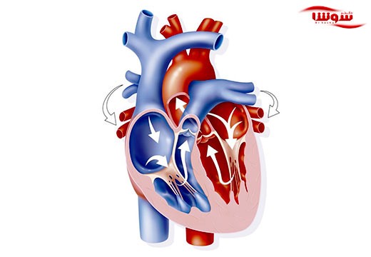 افتادگی دریچه میترال | پرولاپس دریچه میترال (Mitral valve prolapse (MVP