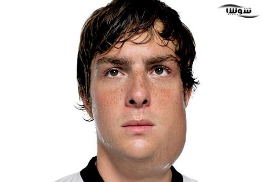 اوریون (Mumps)