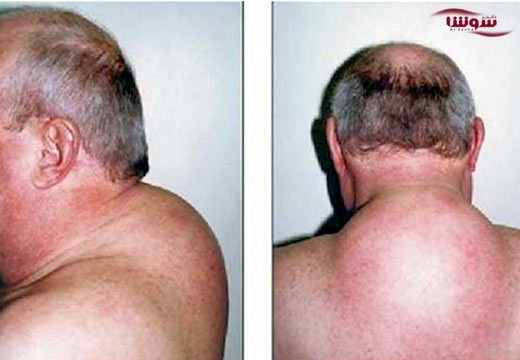 سندروم کوشینگ (Cushing’s syndrome)
