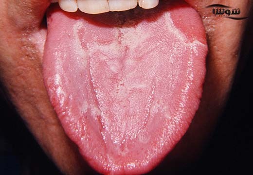 زبان جغرافیایی (geographic tongue)