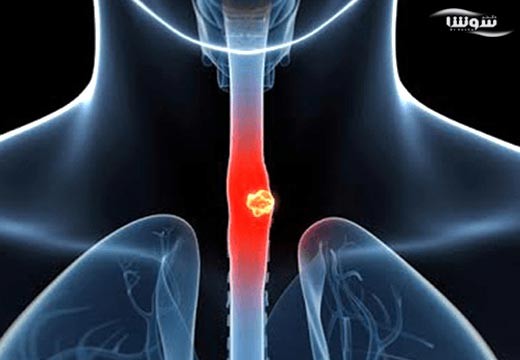 سرطان مری (Esophageal cancer)