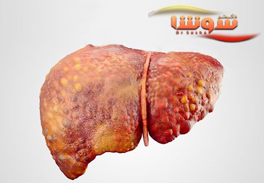 تغذیه و رژیم غذایی مناسب برای بیماری هپاتیت C