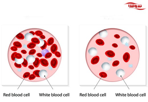 نقص ایمنی متغیر شایع (Common variable immunodeficiency)