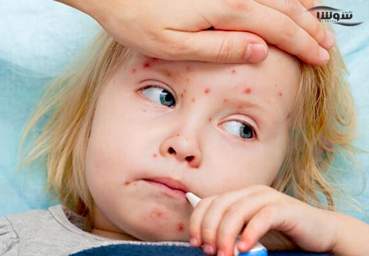 سرخجه (Rubella)