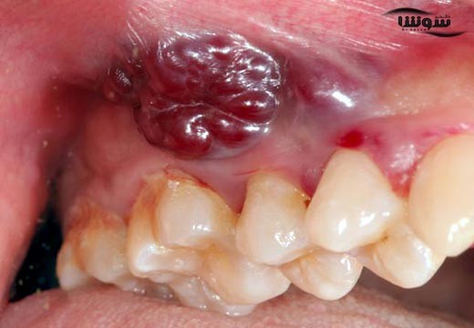 سرطان دهان (mouth cancer)
