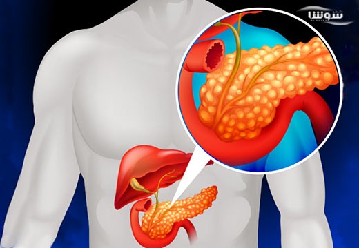 سرطان پانکراس | سرطان لوزالمعده (Pancreatic cancer)