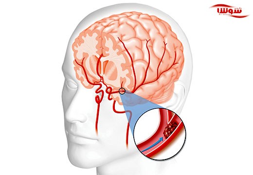 سکته مغزی (stroke)