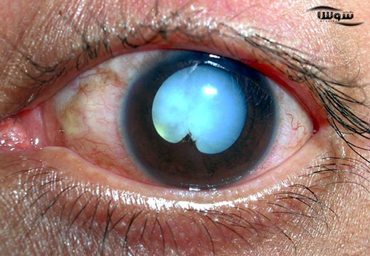 تومور شبکیه | رتینوبلاستوم (Retinoblastoma)