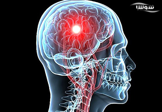 آنسفالیت (Encephalitis)