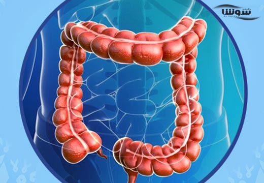 سرطان روده بزرگ (Colon cancer)