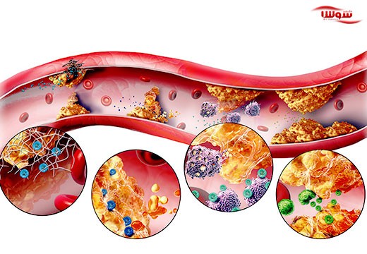 تصلب شرایین یا آترواسکلروز (Atherosclerosis)