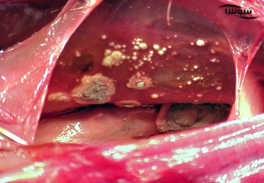 آسپرژیلوزیس (Aspergillosis)