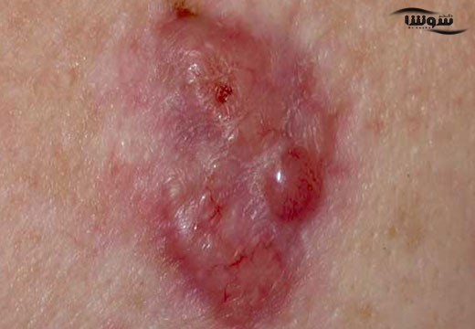سرطان سلول های بازال پوست (Basal cell carcinoma)