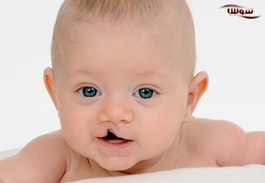 سندروم دی جرج (Digeorge syndrome)