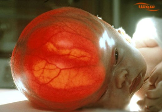 هیدروسفالی | تجمع مایع در مغز (Hydrocephalus)