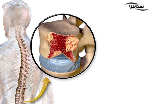 سرطان مولتیپل میلوما ( multiple myeloma cancer)