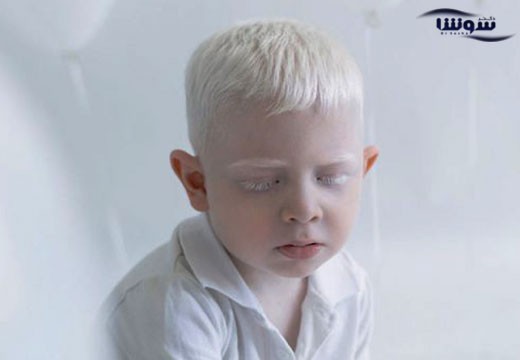 زالی | آلبینیسم (Albinism)