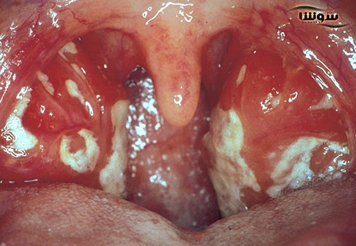 مونونوکلئوز عفونی (Mononucleosis)