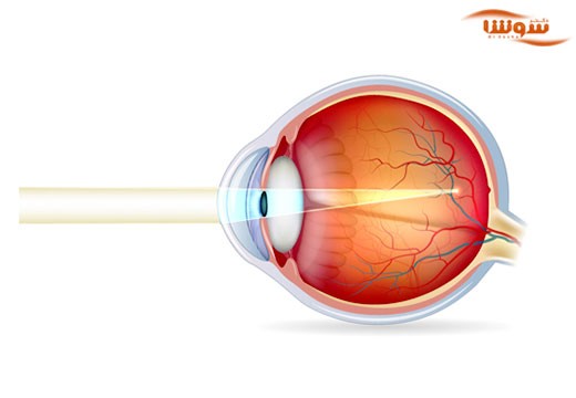 نزدیک بینی (Myopia)