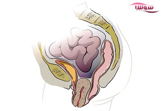 افتادگی رحم (Uterine prolapse)