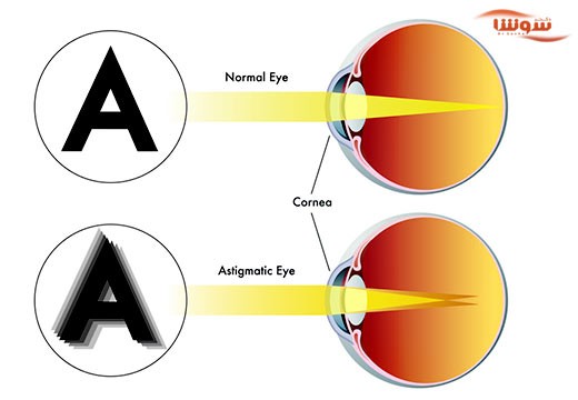 آستیگماتیسم (Astigmatism)
