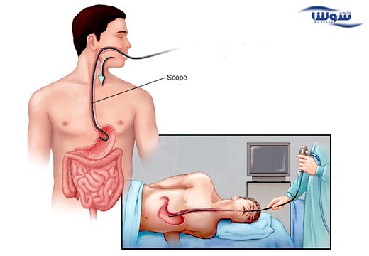 سوء هاضمه | سوزش سر دل (Nonulcer stomach pain)