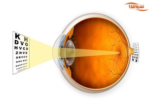 دوربینی (Farsightedness)