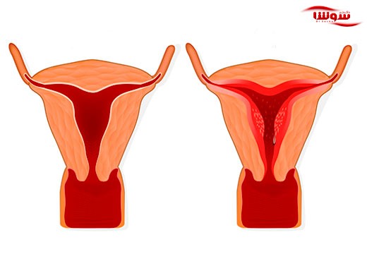 منوراژی | درد شدید قاعدگی (Menorrhagia)